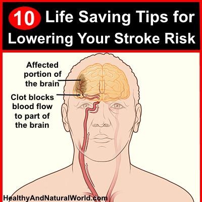 Lowering Your Risk of Stroke